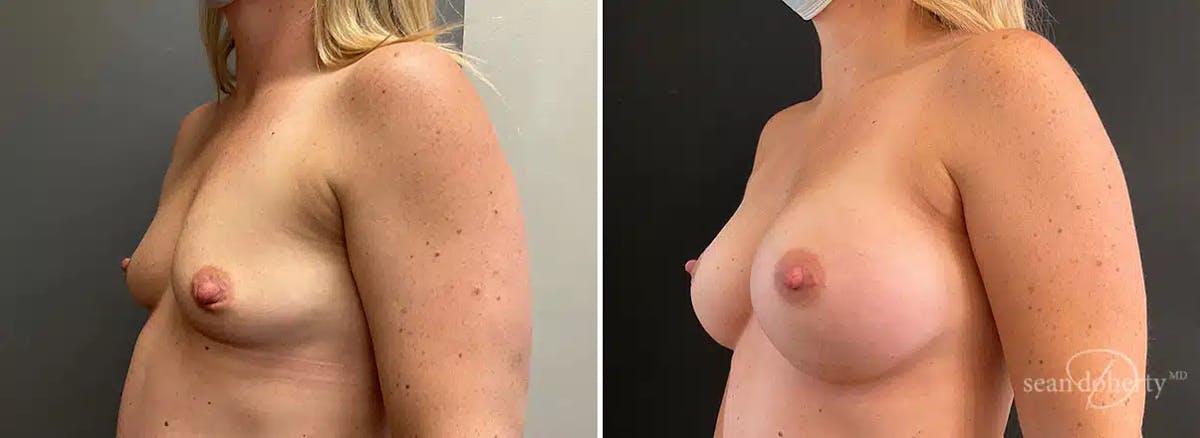 Breast Augmentation Before & After Gallery - Patient 788851 - Image 2