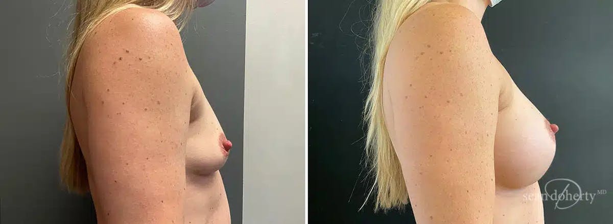 Breast Augmentation Before & After Gallery - Patient 788851 - Image 3