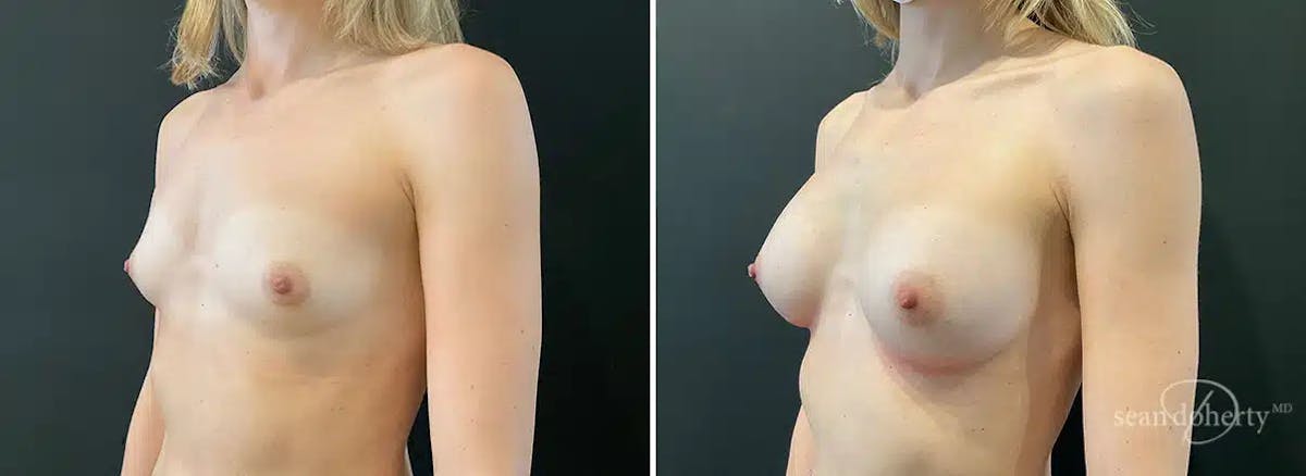 Breast Augmentation Before & After Gallery - Patient 235538 - Image 1