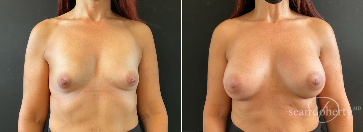 Breast Augmentation Before & After Gallery - Patient 628078 - Image 1