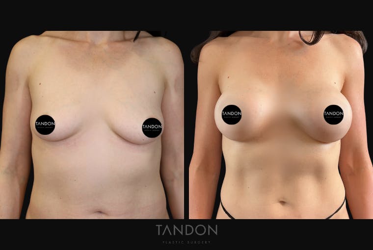Breast Augmentation Before & After Gallery - Patient 675973 - Image 1
