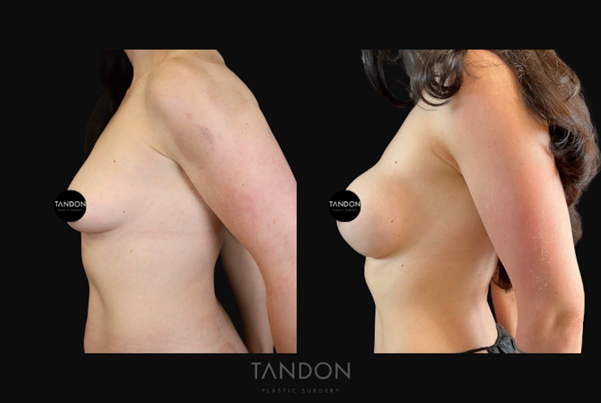 Breast Augmentation Before & After Gallery - Patient 675973 - Image 2