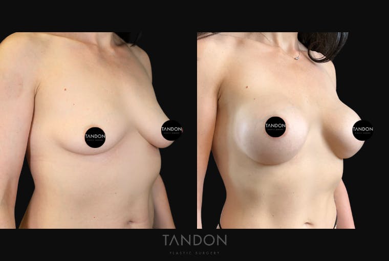 Breast Augmentation Before & After Gallery - Patient 675973 - Image 4