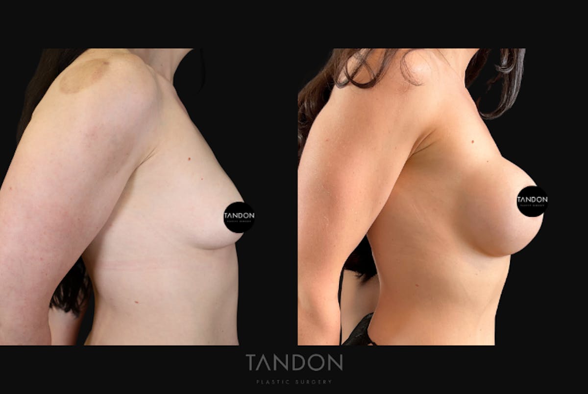 Breast Augmentation Before & After Gallery - Patient 675973 - Image 3