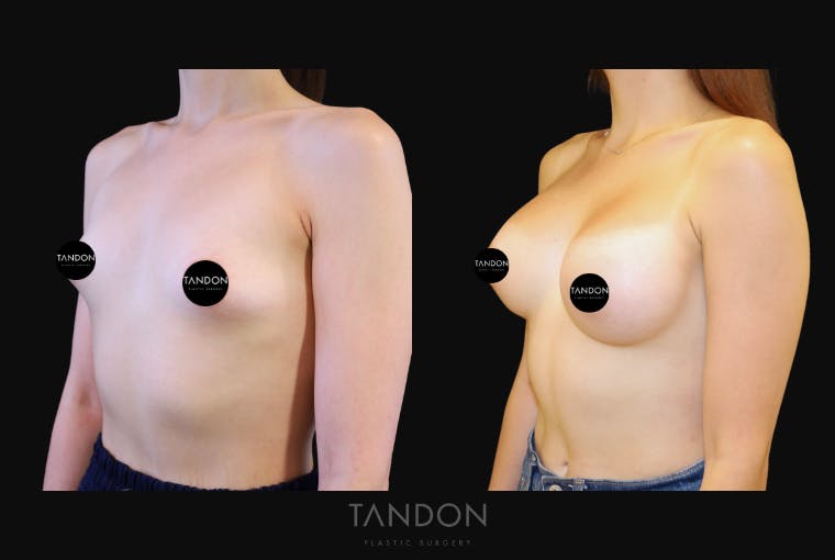Breast Augmentation Before & After Gallery - Patient 676993 - Image 4