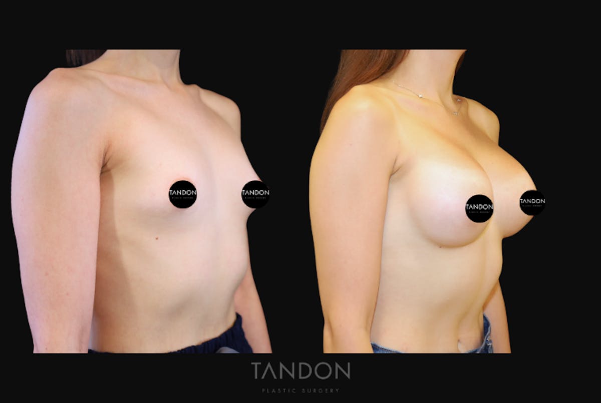 Breast Augmentation Before & After Gallery - Patient 676993 - Image 2