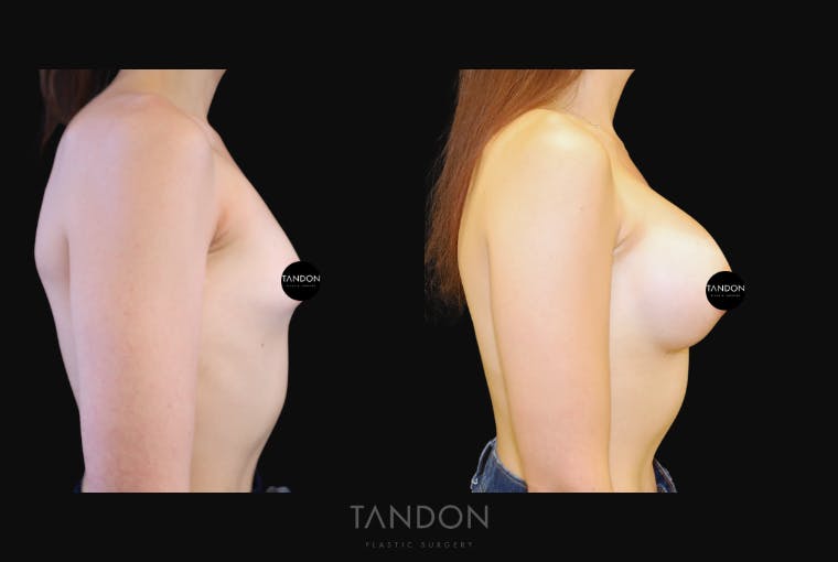 Breast Augmentation Before & After Gallery - Patient 676993 - Image 3