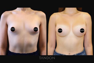 Breast Augmentation Before & After Gallery - Patient 676993 - Image 1