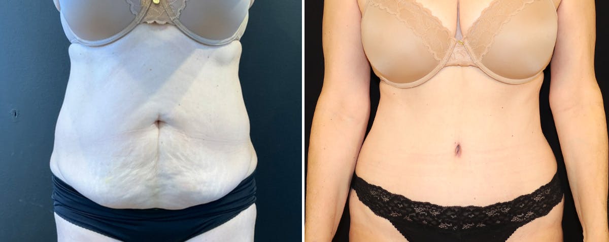 Abdominoplasty (Tummy Tuck) Before & After Gallery - Patient 390137 - Image 1