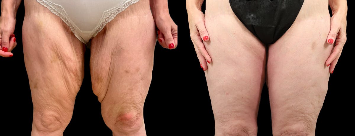 Thigh Lift Before & After Gallery - Patient 195340 - Image 1