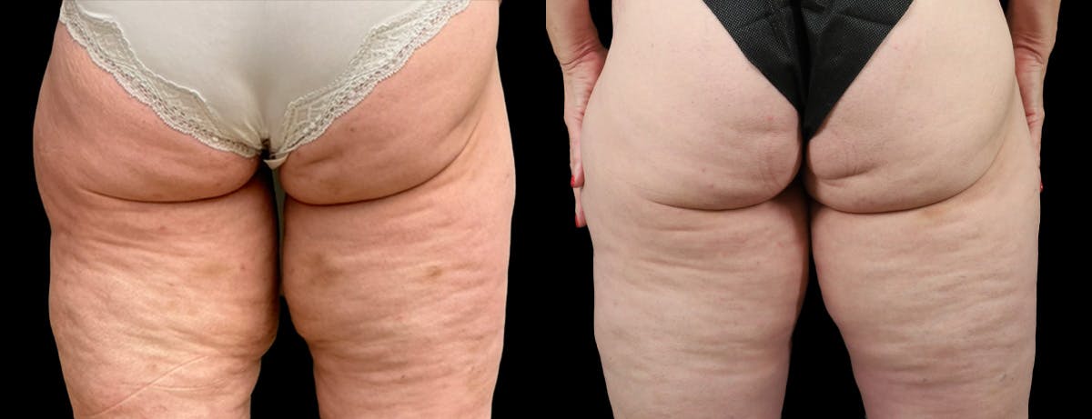 Thigh Lift Before & After Gallery - Patient 195340 - Image 2
