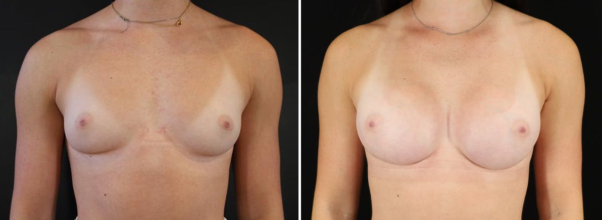 Breast Augmentation Before & After Gallery - Patient 119036 - Image 1
