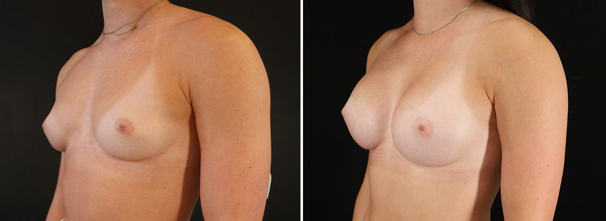 Breast Augmentation Before & After Gallery - Patient 119036 - Image 2