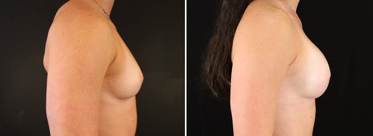 Breast Augmentation Before & After Gallery - Patient 119036 - Image 3