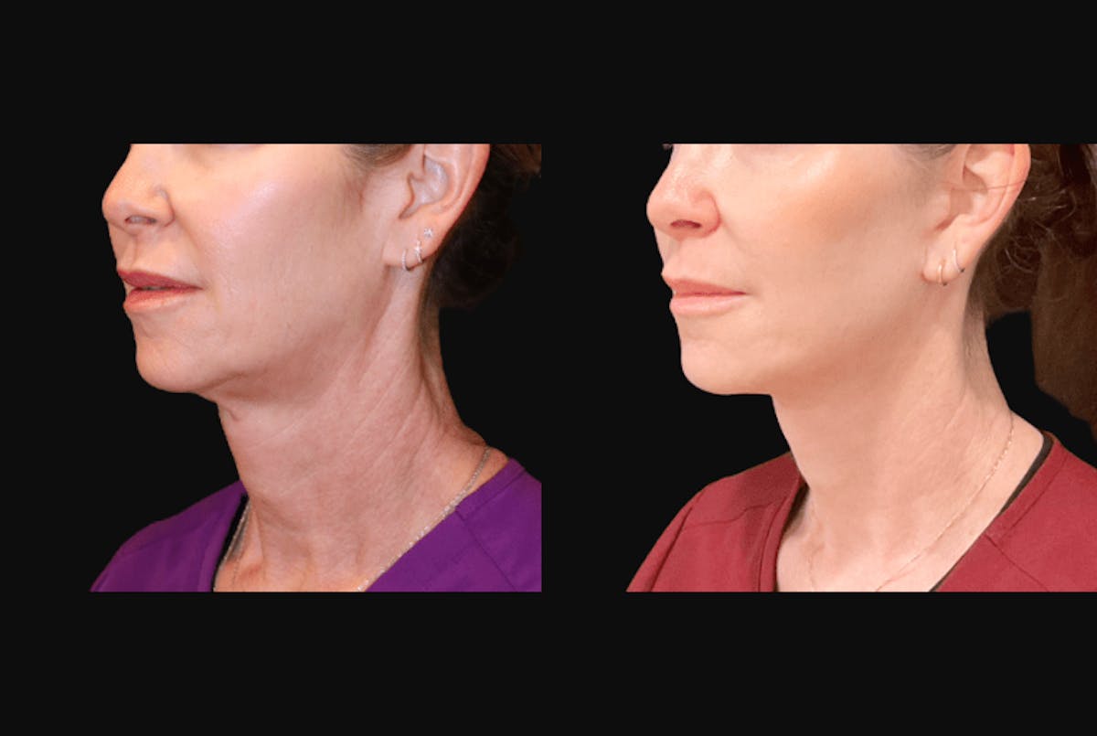 Facelift Before & After Gallery - Patient 368656 - Image 4