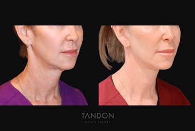 Facelift Before & After Gallery - Patient 368656 - Image 1