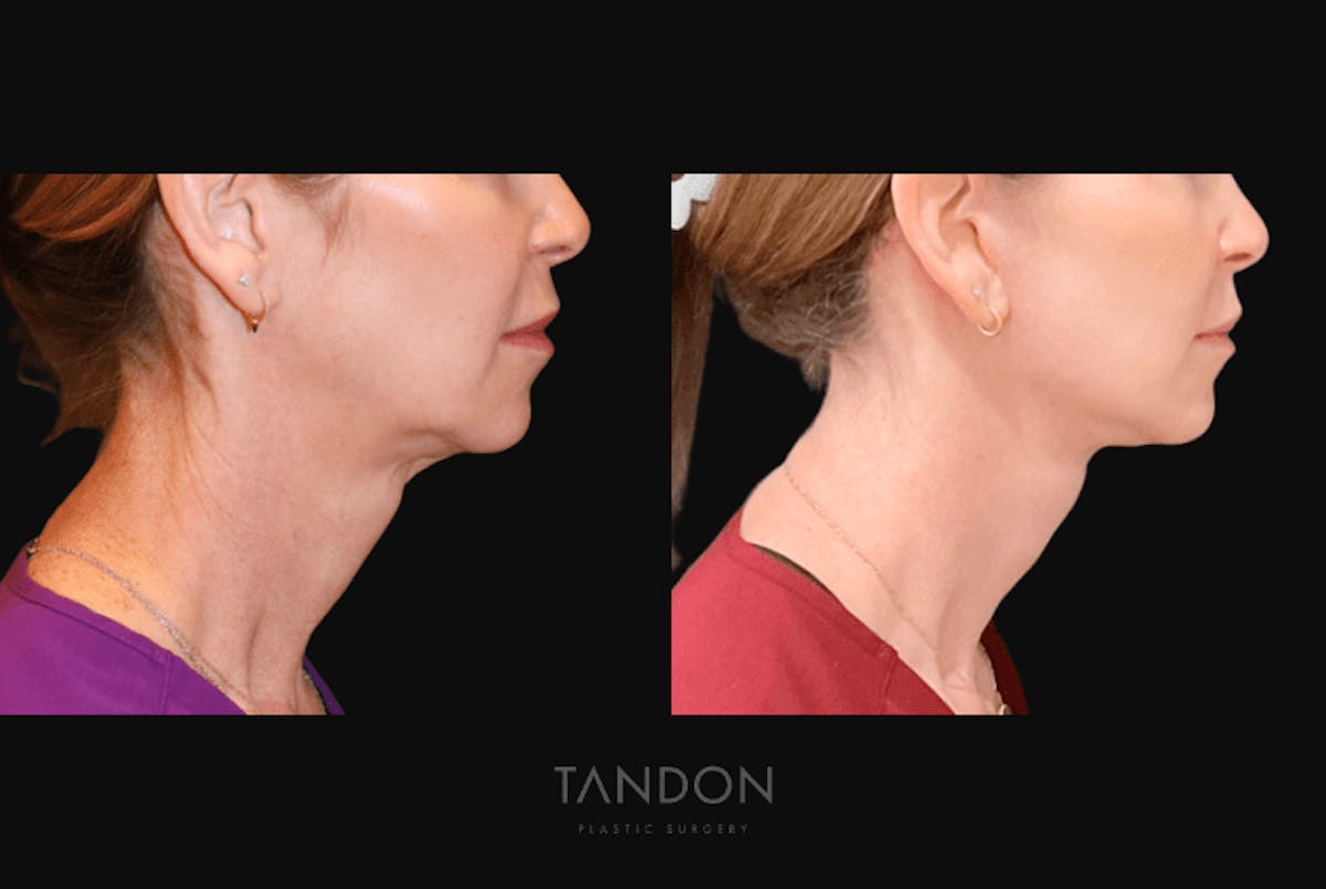 Facelift Before & After Gallery - Patient 368656 - Image 2