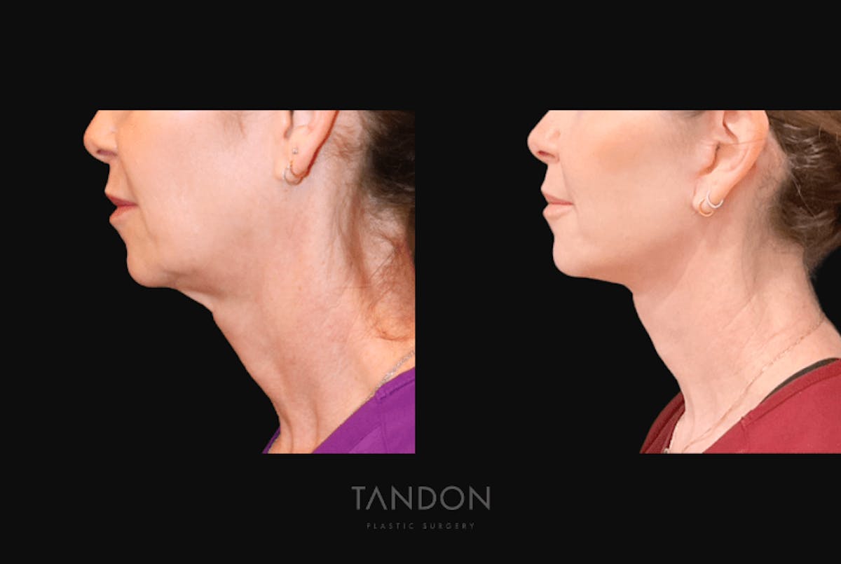Facelift Before & After Gallery - Patient 368656 - Image 3