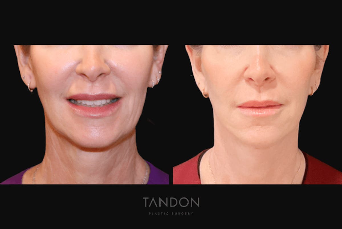 Facelift Before & After Gallery - Patient 368656 - Image 1