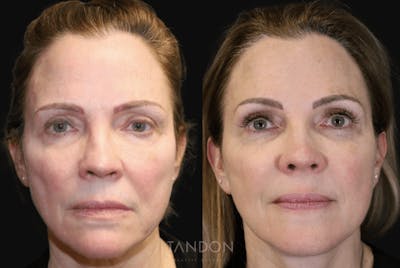 Facelift Before & After Gallery - Patient 295812 - Image 1
