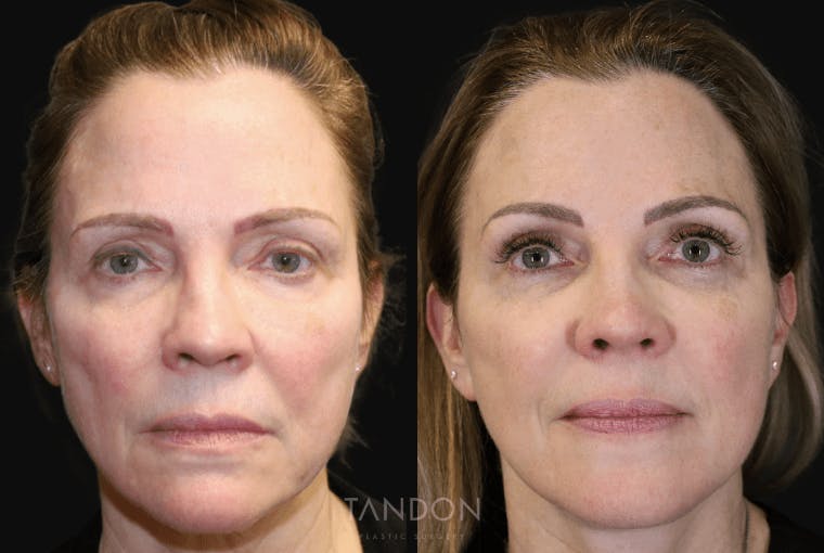 Facelift Before & After Gallery - Patient 295812 - Image 1