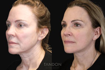 Neck Lift Before & After Gallery - Patient 133214 - Image 1