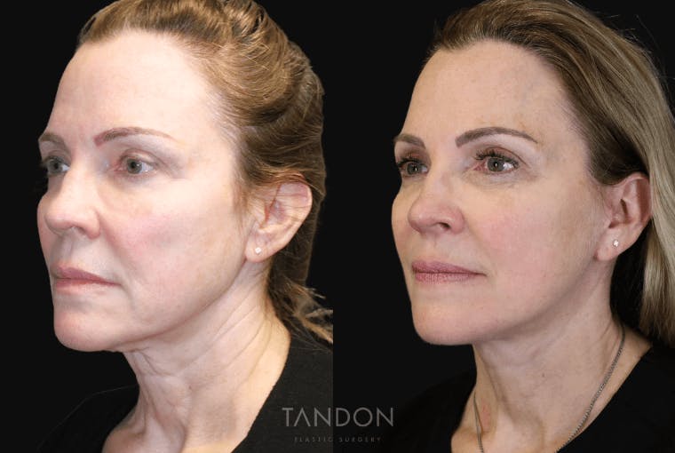 Facelift Before & After Gallery - Patient 295812 - Image 4