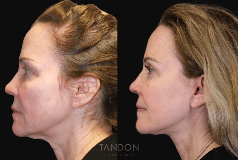 Facelift Before & After Gallery - Patient 295812 - Image 5