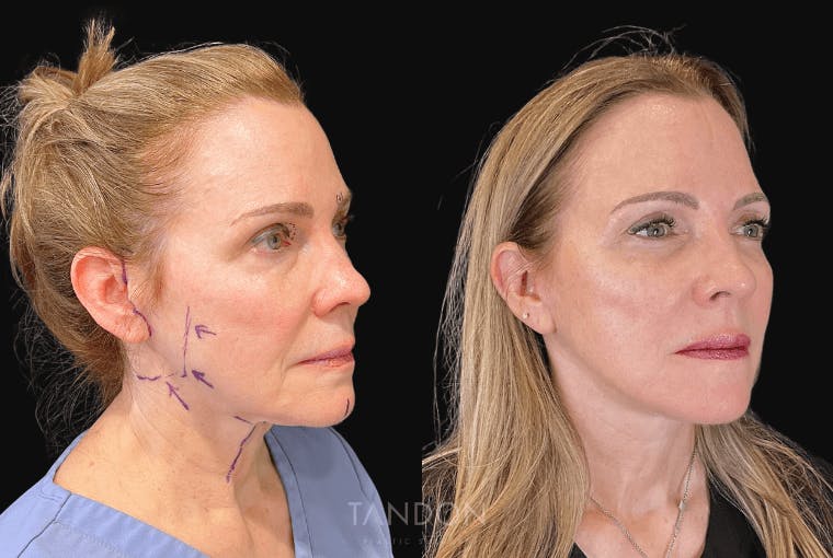 Facelift Before & After Gallery - Patient 295812 - Image 2
