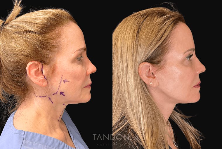 Facelift Before & After Gallery - Patient 295812 - Image 3
