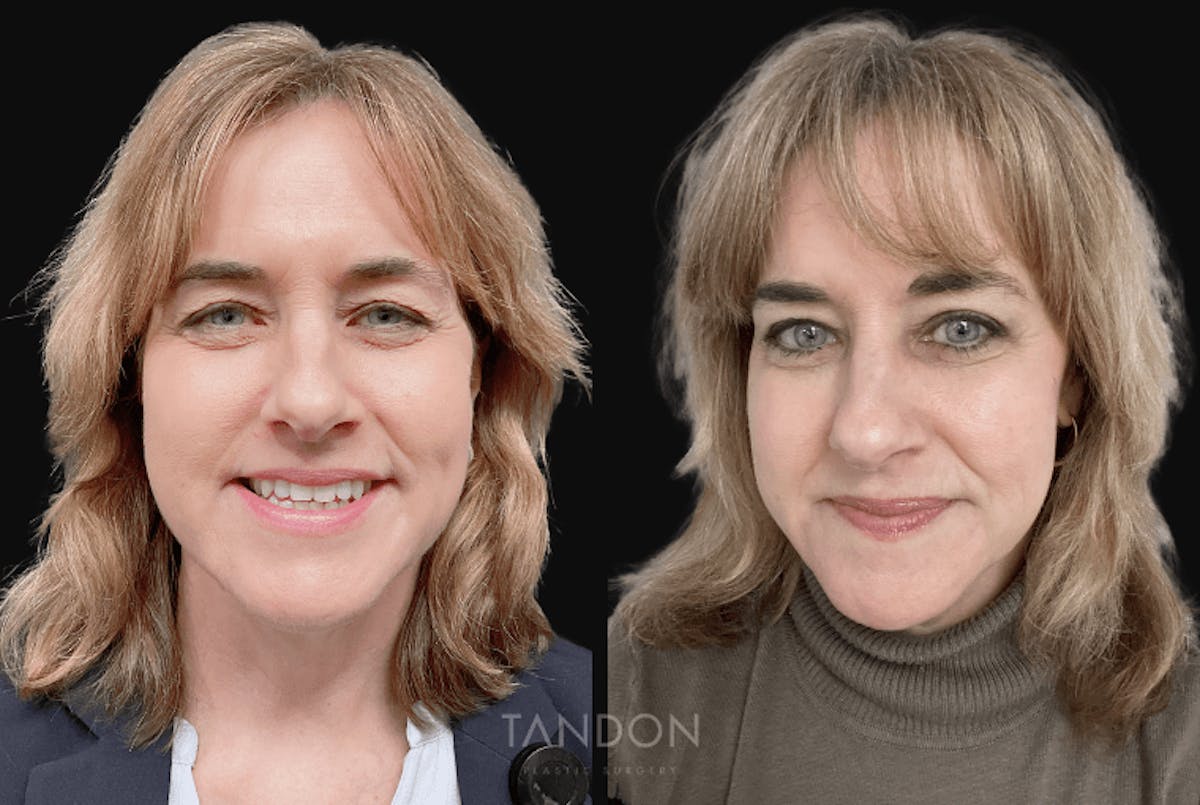 Blepharoplasty Before & After Gallery - Patient 241951 - Image 1