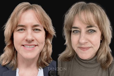 Blepharoplasty Before & After Gallery - Patient 241951 - Image 1