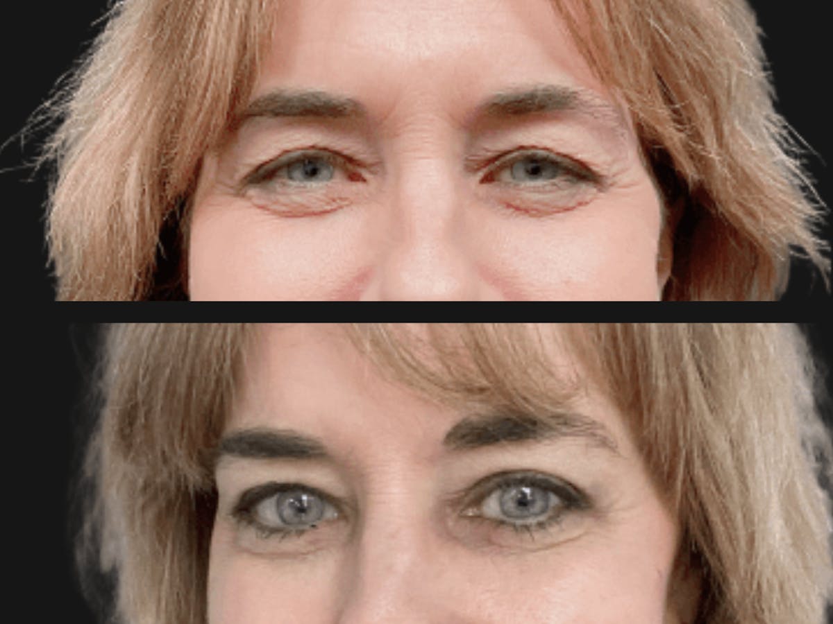 Blepharoplasty Before & After Gallery - Patient 241951 - Image 2