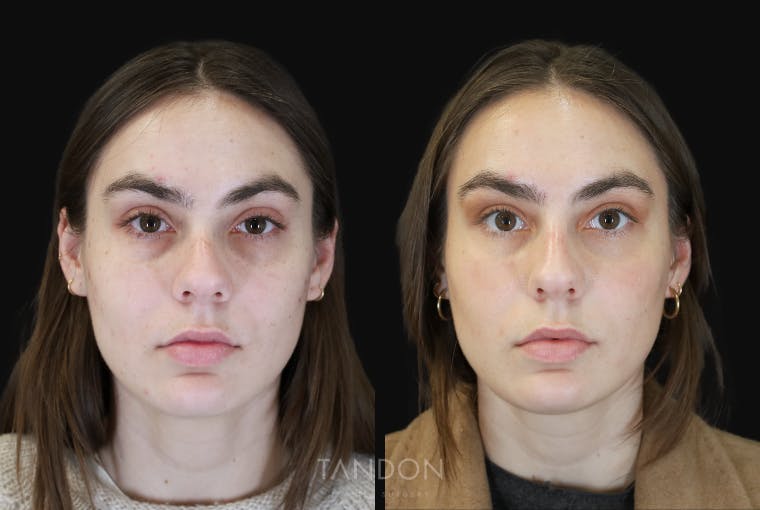 Non Surgical Rhinoplasty Before & After Gallery - Patient 308498 - Image 3