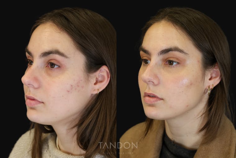Non Surgical Rhinoplasty Before & After Gallery - Patient 308498 - Image 4