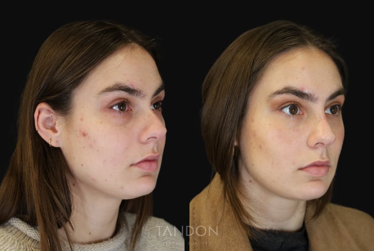 Non Surgical Rhinoplasty Before & After Gallery - Patient 308498 - Image 2