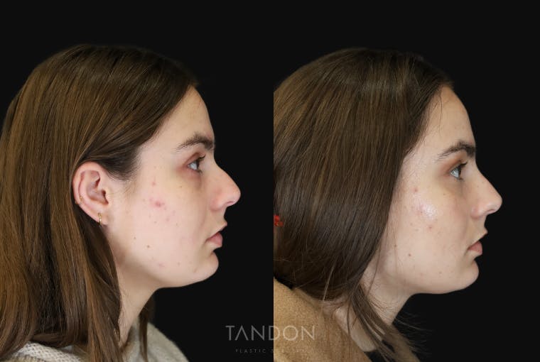 Non Surgical Rhinoplasty Before & After Gallery - Patient 308498 - Image 1