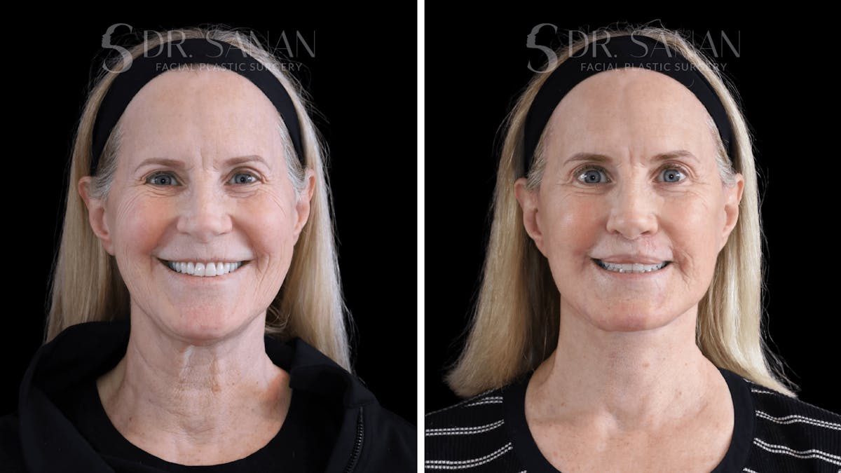 Deep Plane Facelift Before & After Gallery - Patient 376146 - Image 1