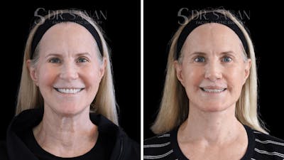 Neck Lift Before & After Gallery - Patient 554149 - Image 1