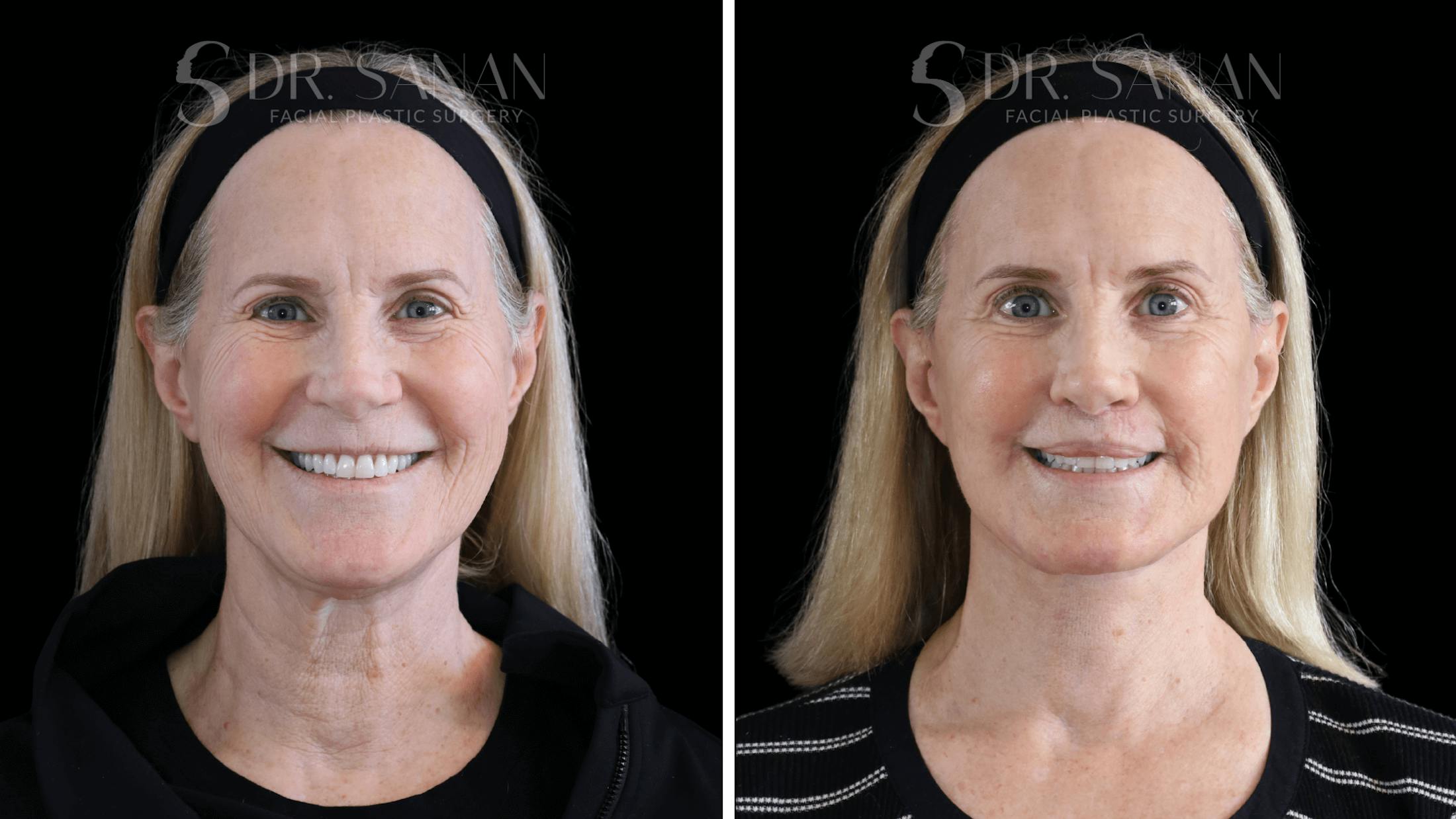 Blepharoplasty Before & After Gallery - Patient 158912 - Image 2