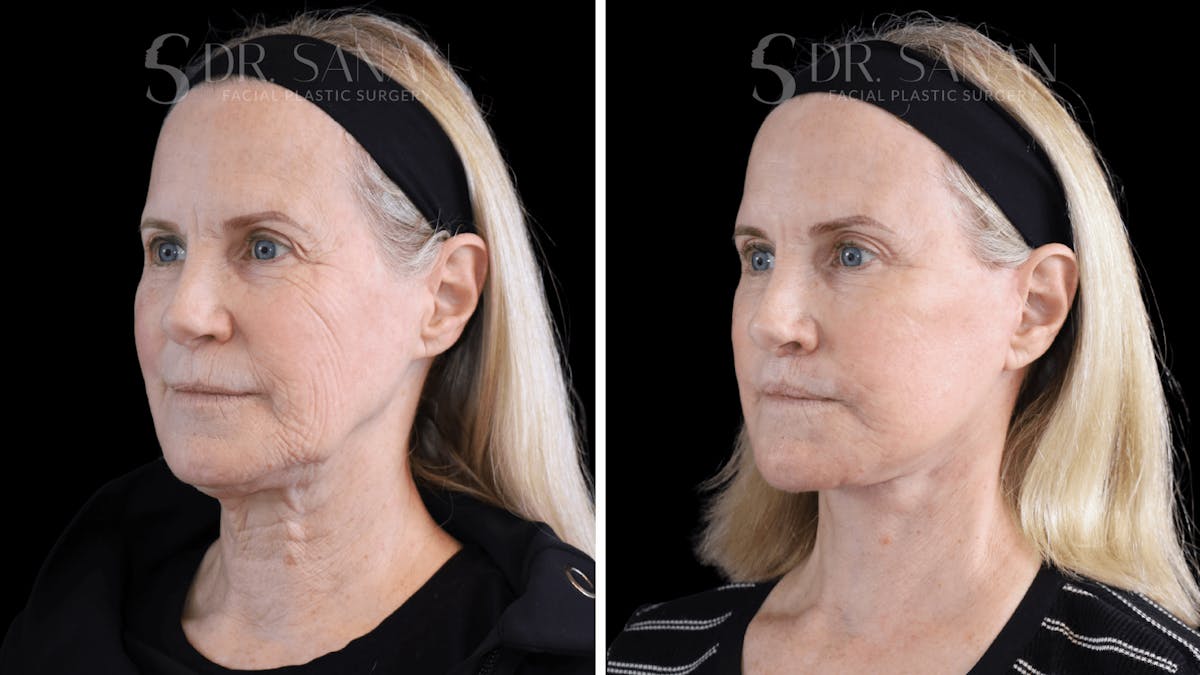 Deep Plane Facelift Before & After Gallery - Patient 376146 - Image 4
