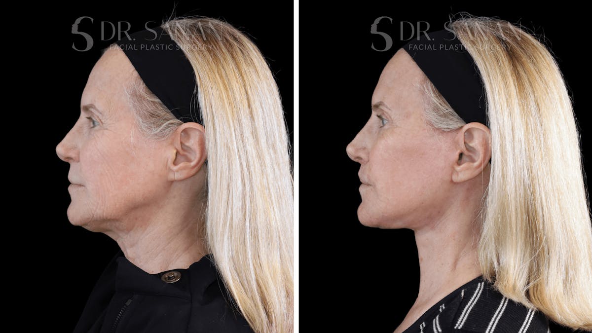 Deep Plane Facelift Before & After Gallery - Patient 376146 - Image 3