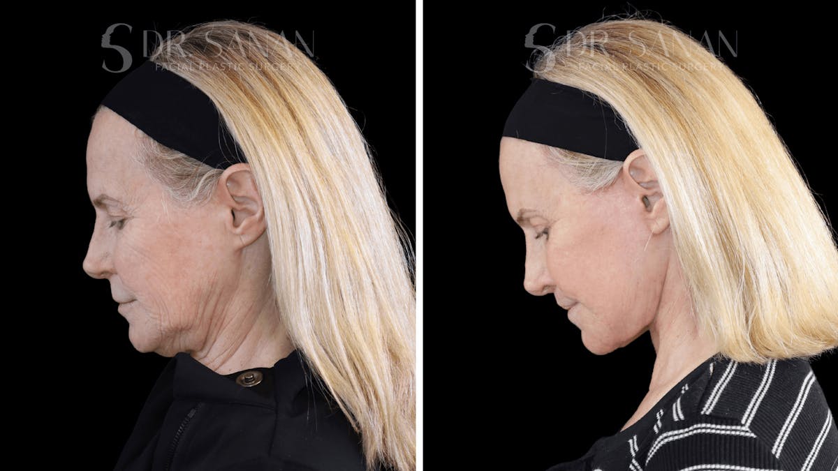 Deep Plane Facelift Before & After Gallery - Patient 376146 - Image 2