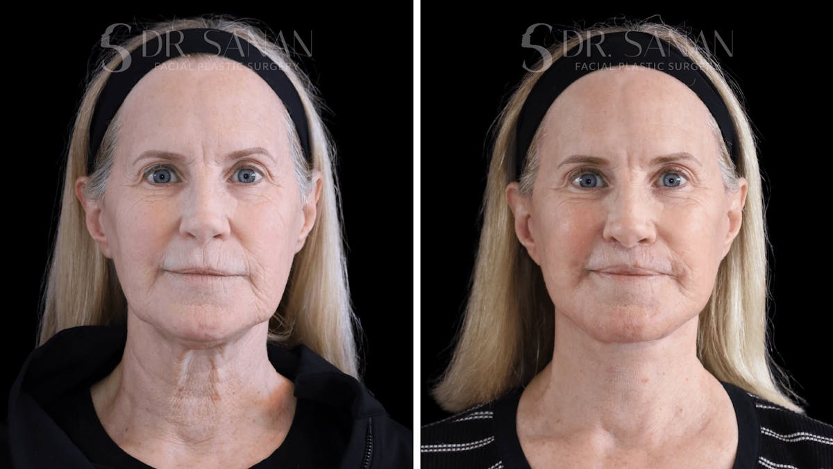 Deep Plane Facelift Before & After Gallery - Patient 376146 - Image 5