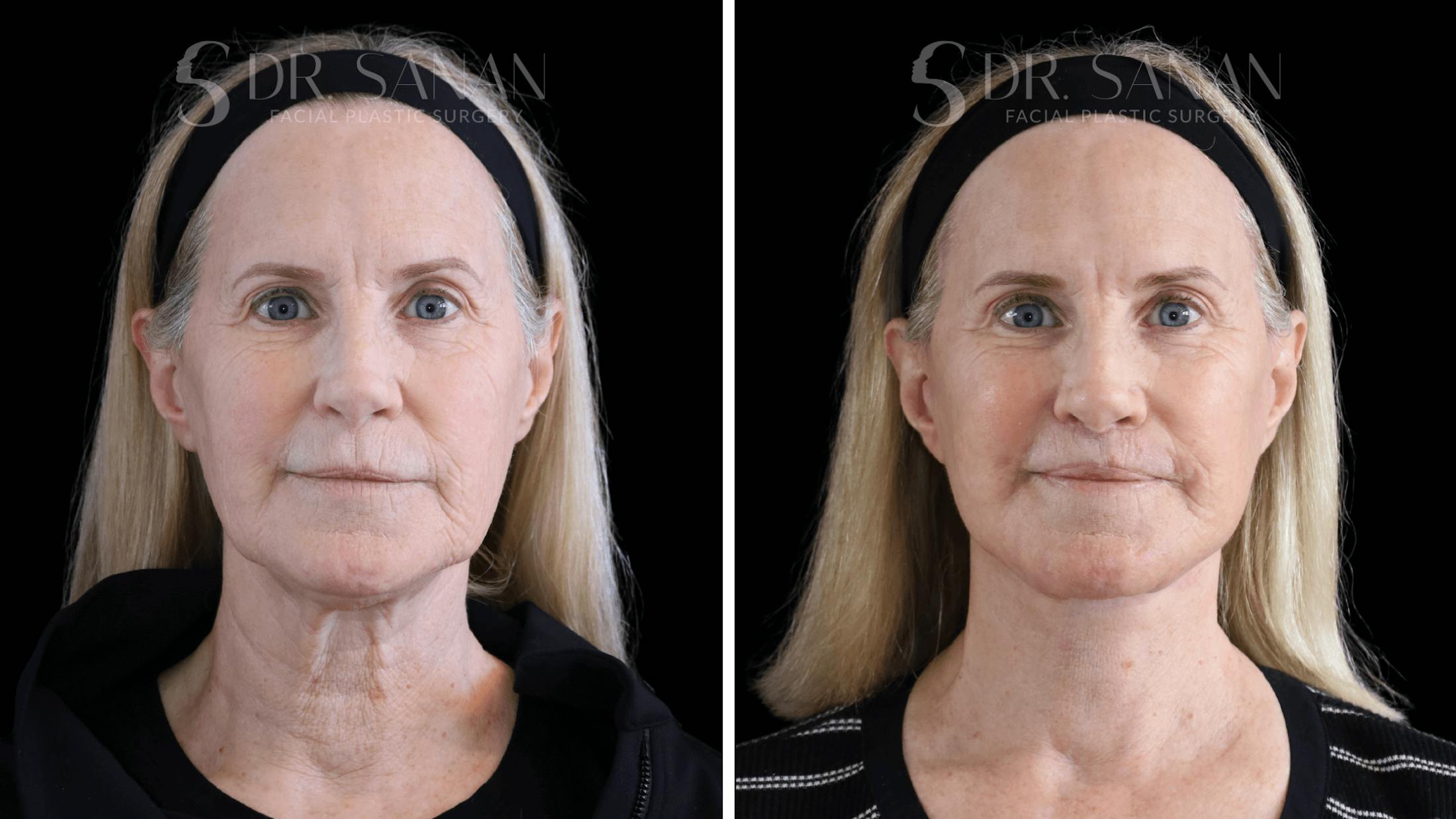 Blepharoplasty Before & After Gallery - Patient 158912 - Image 3