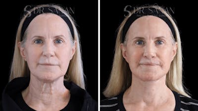 Lip Lift Before & After Gallery - Patient 389953 - Image 1