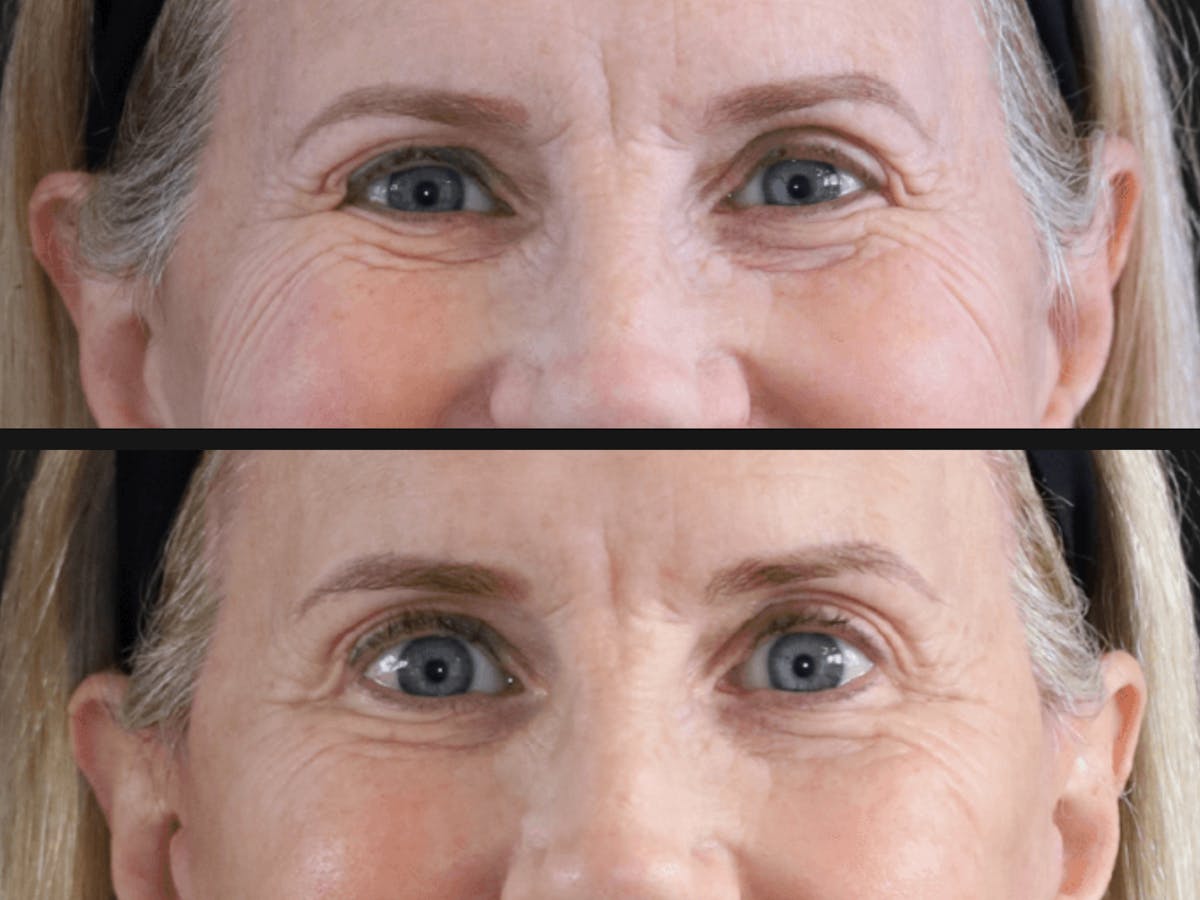 Brow Lift Before & After Gallery - Patient 424116 - Image 1