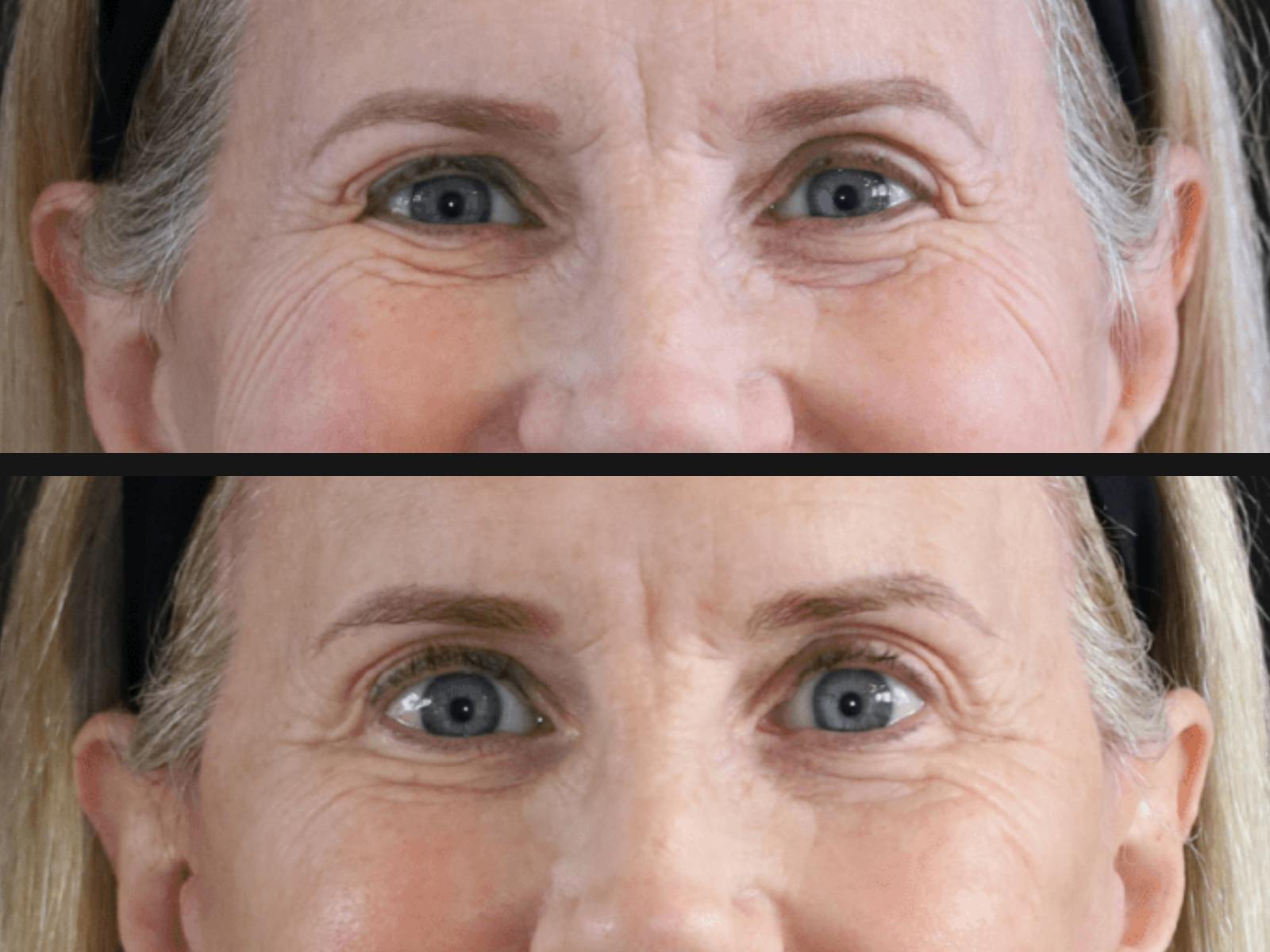 Blepharoplasty Before & After Gallery - Patient 158912 - Image 1