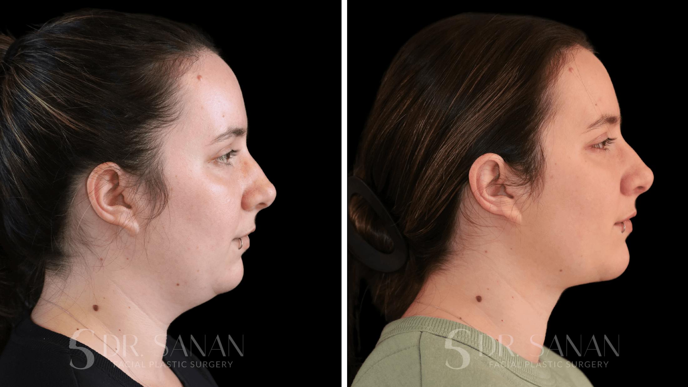 Neck Lift Before & After Gallery - Patient 306343 - Image 2