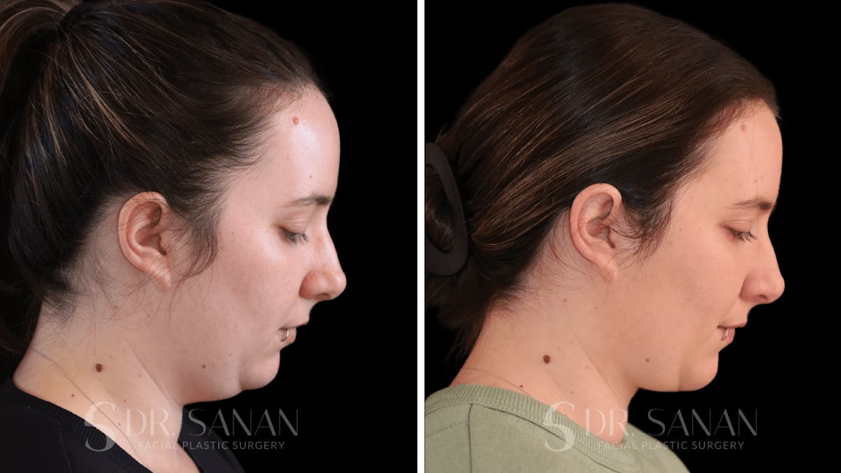 Buccal Fat Reduction Before & After Gallery - Patient 612930 - Image 3